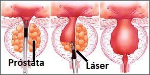 prostata-laser prostata-laser